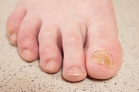 What Causes Toenails to Turn Yellow?